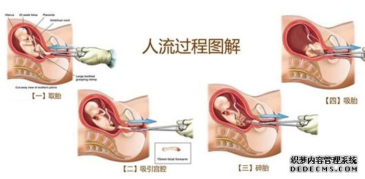 无痛人流简介(图1)