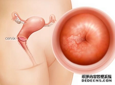 宫颈炎有哪些症状?(图1) 宫颈炎有哪些症状?(图1)