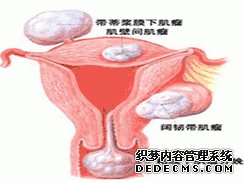 子宫肥大如何鉴别(图1) 子宫肥大如何鉴别(图1)