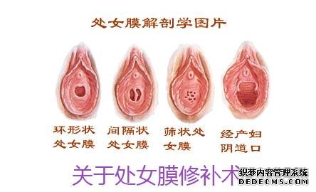 处女膜修补手术过程(图1) 处女膜修补手术过程(图1)